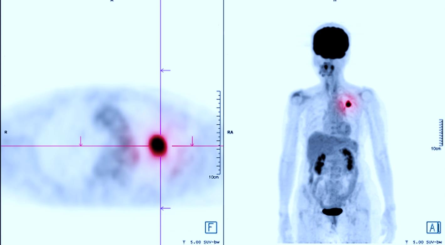 Diagnostic Radiopharmacy: Overview And Market Access Considerations